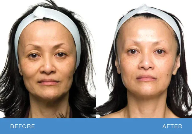 Bio Therapeutic Bt-sculpt®