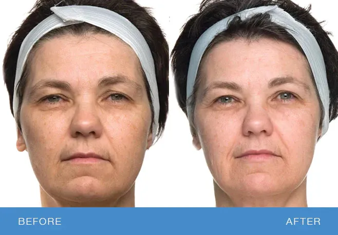 Bio Therapeutic Bt-sculpt®