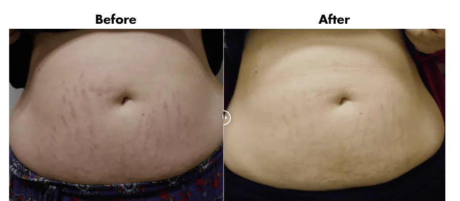 Stratamark Stretch Mark Gel 50g